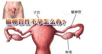 输卵管性不孕试管