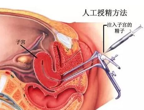 看看人工授精的过程 当心其带来的危害