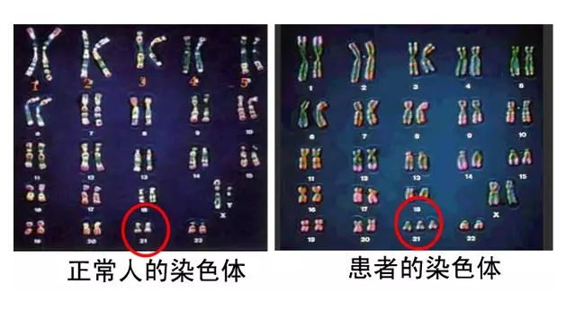 染色体异常，第三代试管婴儿技术成功助孕