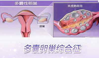 多囊卵巢综合症可以自然周期取卵吗