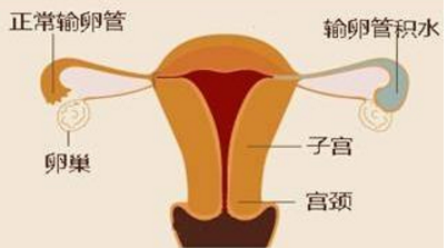 输卵管堵塞该手术还是该做试管婴儿