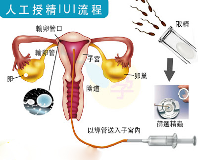 坤和专家详解：宫腔内人工授精（IUI）技术