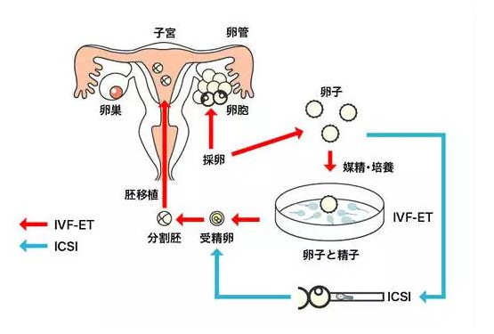 试管婴儿PK自然妊娠的宝宝哪个好