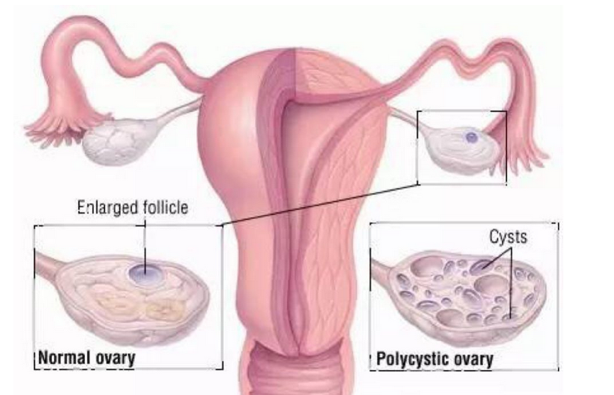 多囊卵巢患者可以做试管婴儿吗