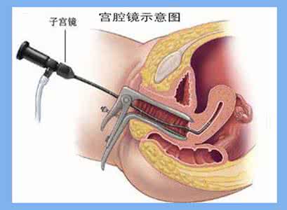 试管婴儿前为什么要做宫腔镜检查