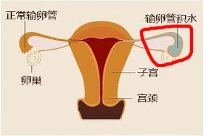 试管婴儿前不同手术方法处理输卵管积水的效果