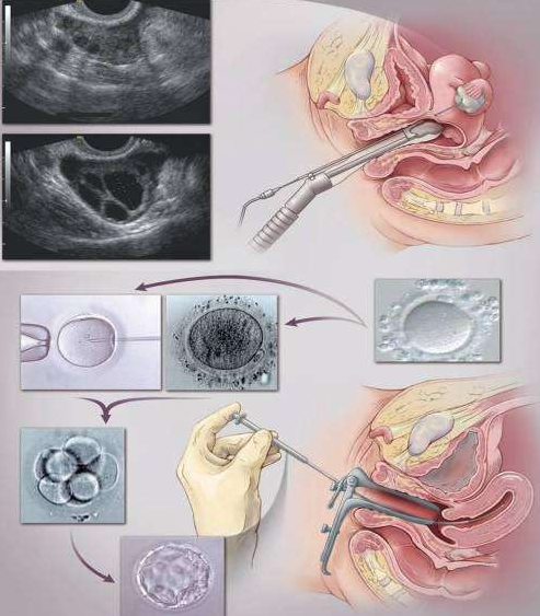 详解试管婴儿过程中胚胎移植的全过程