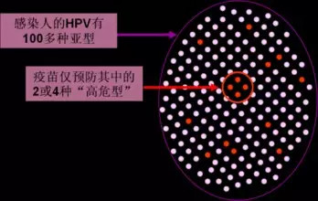 80%女生都会感染的性病病毒HPV你知道多少