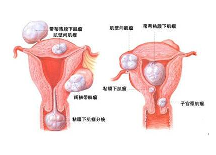 子宫肌瘤会影响受孕吗，能做试管婴儿吗？