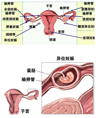 发生宫外孕后，还适合做试管婴儿吗