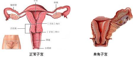 单角子宫可以做广州试管婴儿吗？成功率高吗？