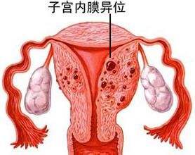 子宫内膜异位能做澳门试管婴儿吗？成功率多高？