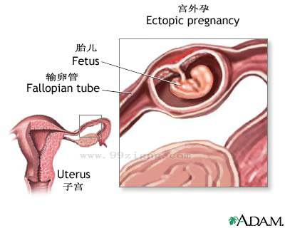 遇到宫外孕澳门试管婴儿如何提高成功率