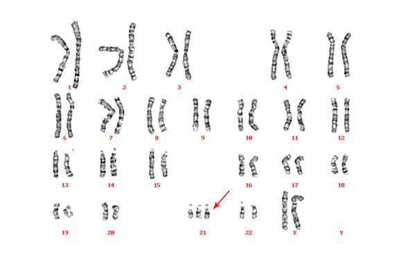 唐氏综合症发病机理 基因检测实现优生
