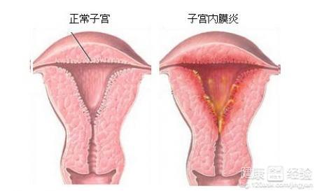 针对这4种不孕病 坤和专家教您选择适合的试管方案