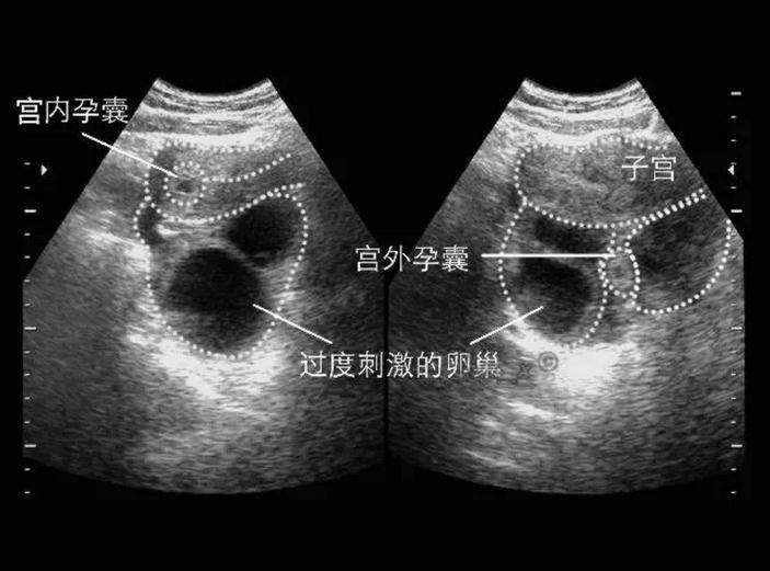 为什么通过试管婴儿技术助孕也会出现宫外孕