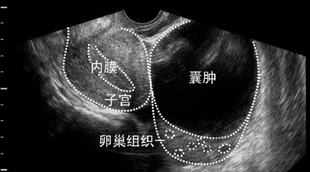 卵巢黄体囊肿不孕做试管婴儿如何成功好孕