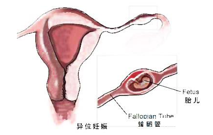 结扎可以避免试管婴儿宫外孕吗