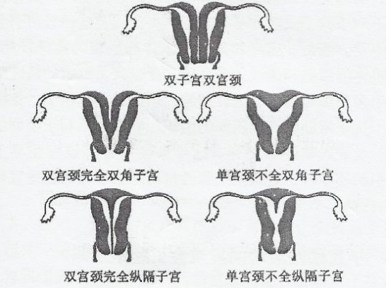 子宫畸形可以做广州试管婴儿助孕吗