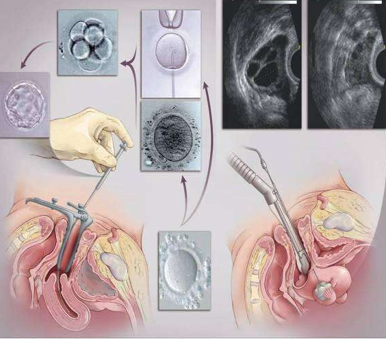 澳门试管婴儿胚胎移植中需要注意的几个问题