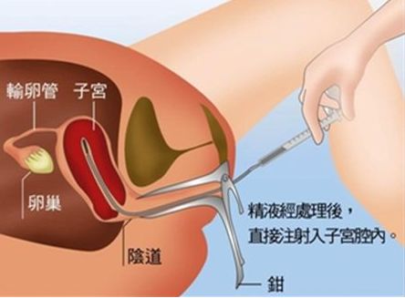 李博士讲解：人工授精和常规试管婴儿两者区别