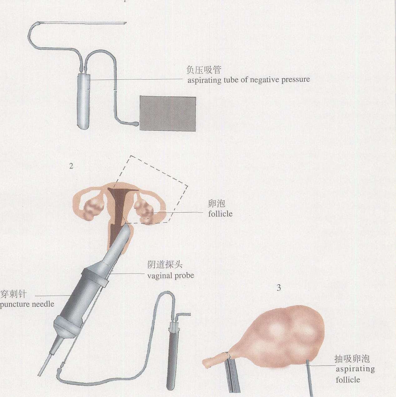 澳门试管婴儿流程中的取卵环节需要注意什么