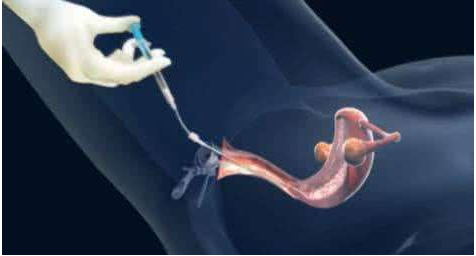 坤和体外受精-胚胎移植技术详解