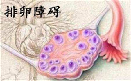 排卵障碍如何做上海试管婴儿