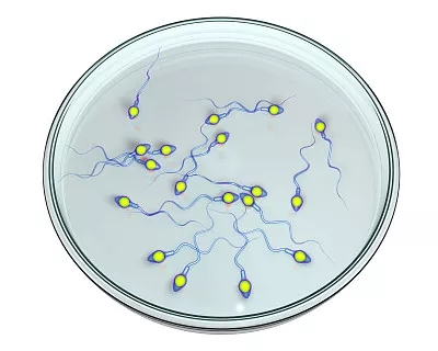 男性HIV精子助孕