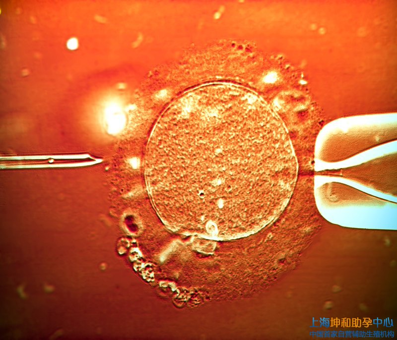 上海助孕公司：上海供卵试管包性别多少钱？
