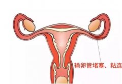 输卵管粘连，能不能直接试管婴儿助孕？