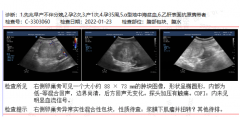 输卵管堵塞导致迟迟未孕，求子心愿终在坤和实现