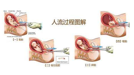 流产次数与不孕不育的发生几率成正比