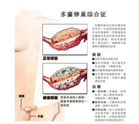 多囊卵巢怎么调周期 促排卵！